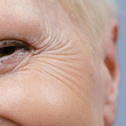 Fine Lines & Wrinkles