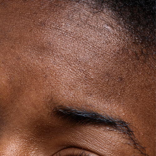 Dry & Dehydrated Skin