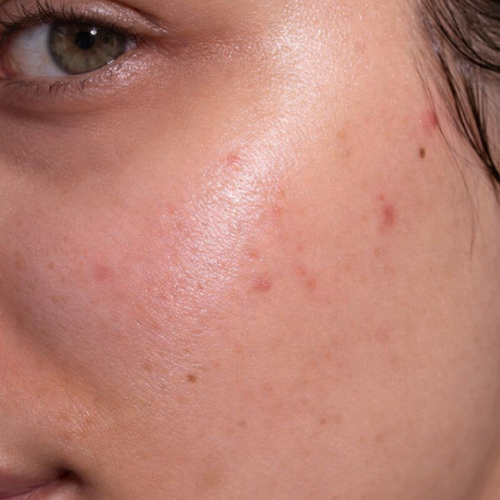 Blemish-Prone Skin