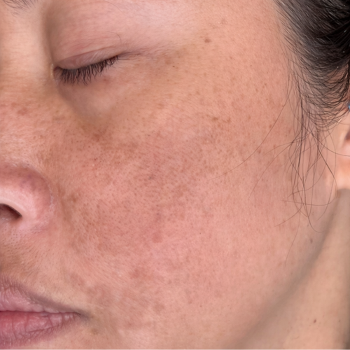 Hyperpigmentation & Dark Spots