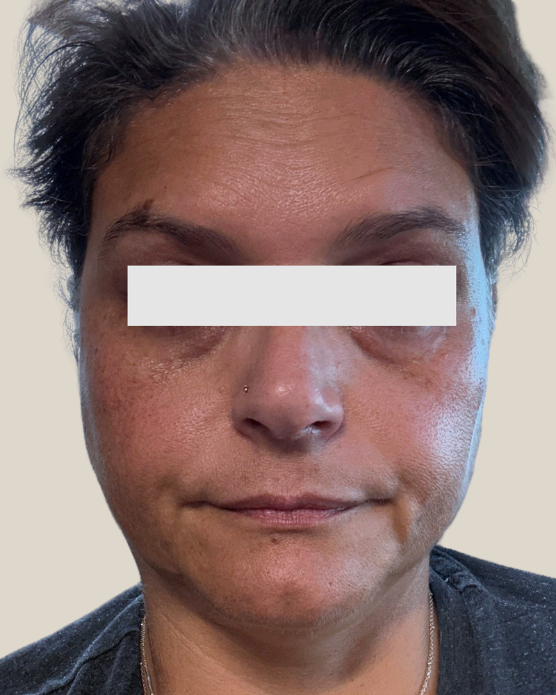 Clarify — Before