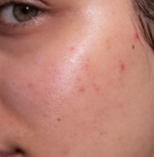 Blemish-Prone Skin