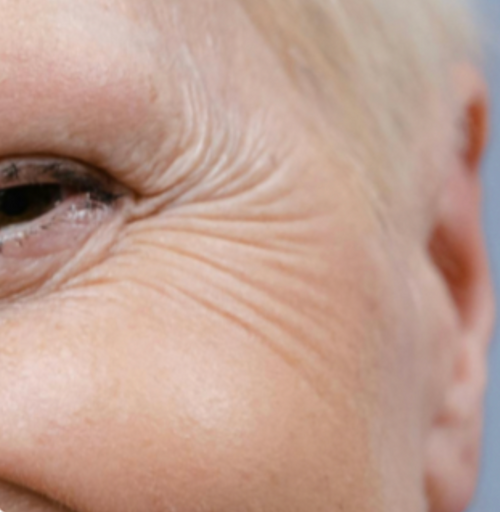 Fine Lines & Wrinkles