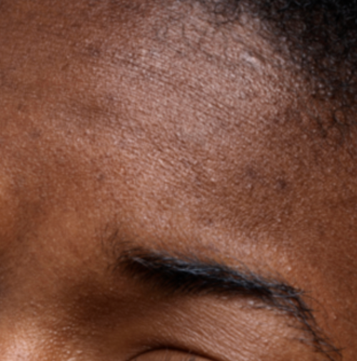 Dry & Dehydrated Skin