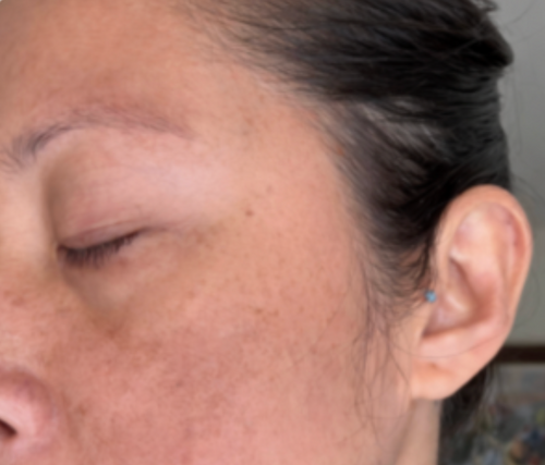 Hyperpigmentation & Dark Spots