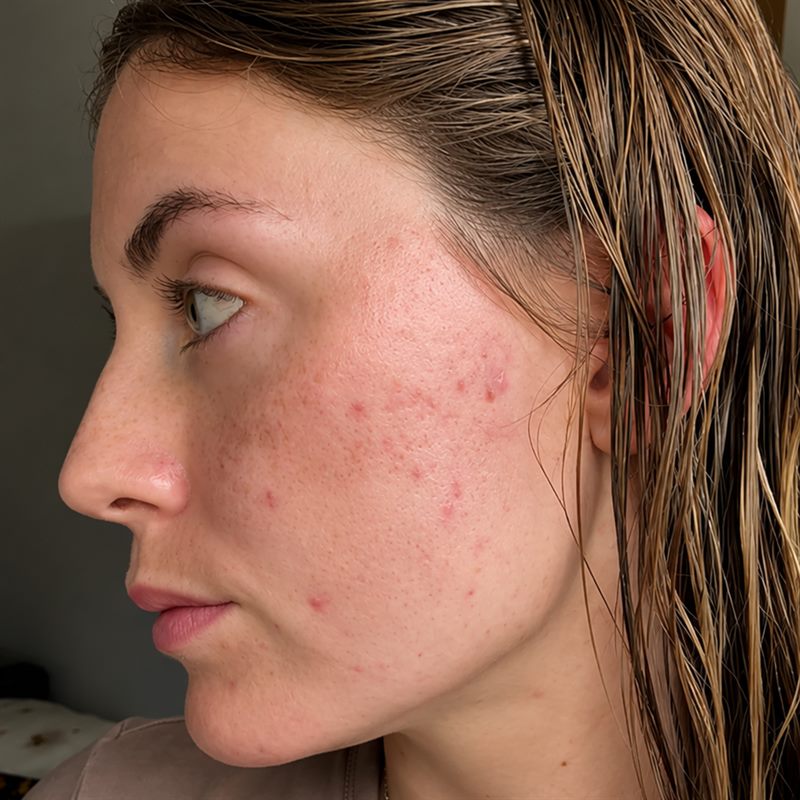 Fades post-blemish marks